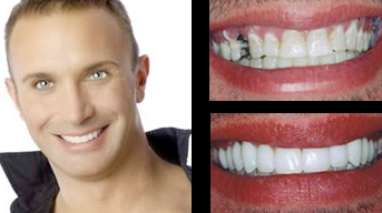 Dental Implants Image