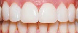 After Porcelain Veneers