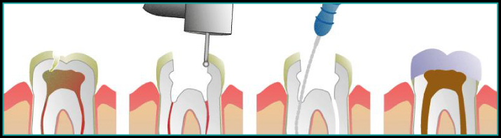 Root Canal